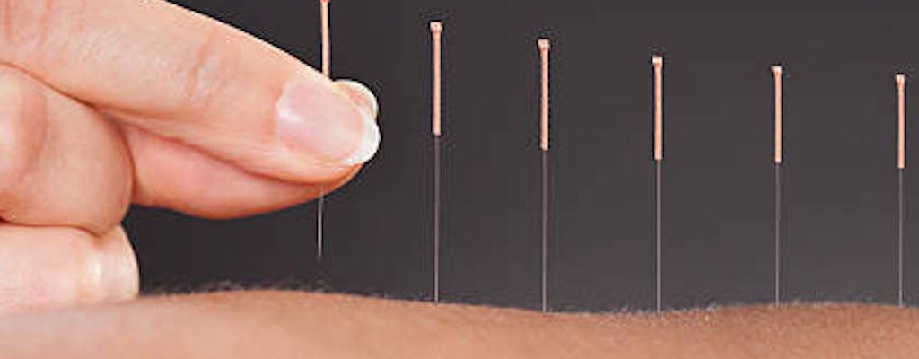 Acupuncture – Pain Relief And So Much More