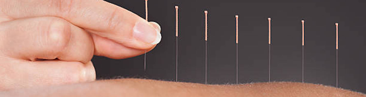 Acupuncture – Phoenix Health And Wellbeing