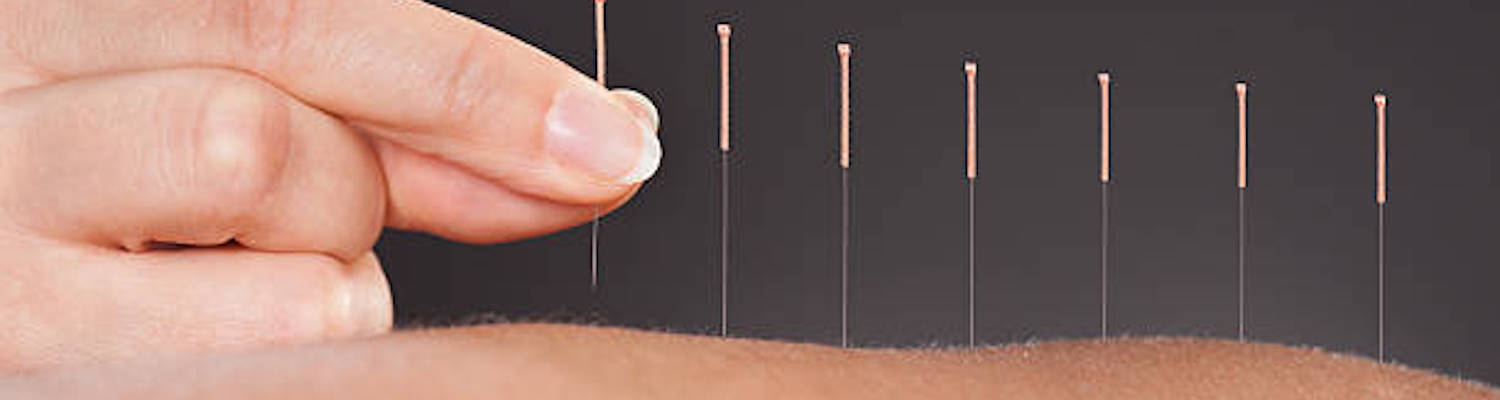 Acupuncture – Pain Relief And So Much More