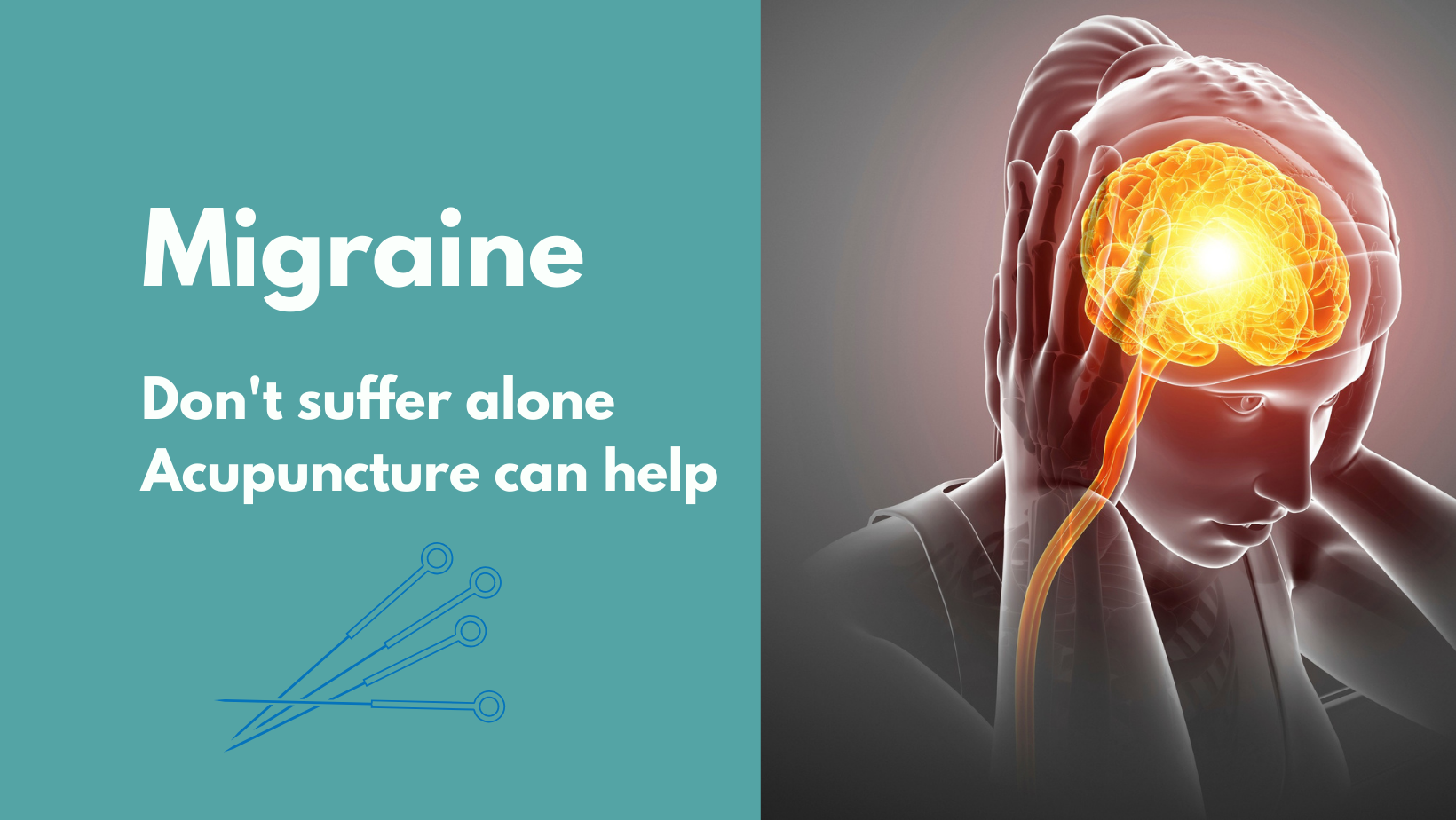 Acupuncture Can Treat Migraine